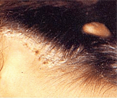Очаговая алопеция у мужчин: лечение гнездового облысения на голове, причины, симптомы, профилактика